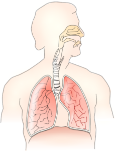 Bronchitis