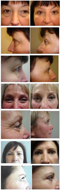 Blepharoplasty