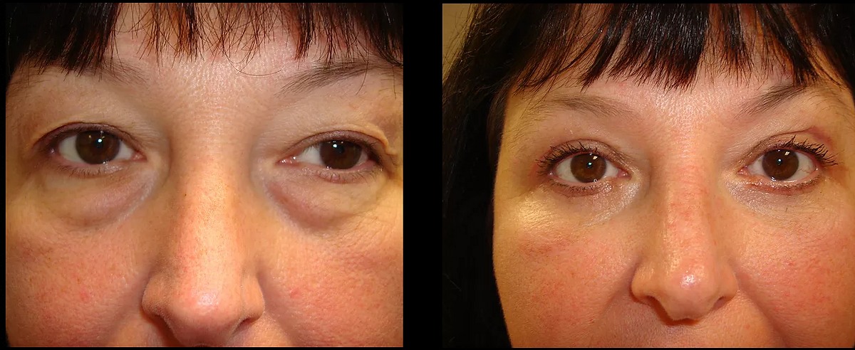  Blepharoplasty