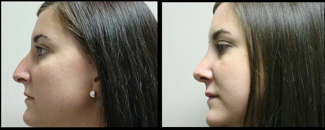 Rhinoplasty