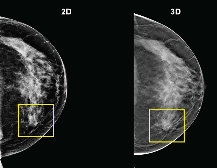 Breast Biospy