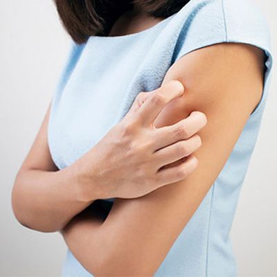 Hives & Swelling - Common Causes, Symptoms, & Treatment