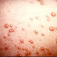  Chicken Pox (Varicella)