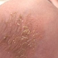 Cradle Cap