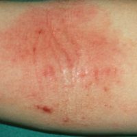 Eczema