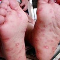  Hand Foot and Mouth Disease