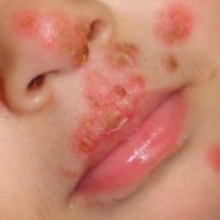 Impetigo