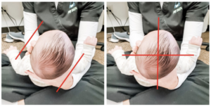 Plagiocephaly