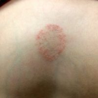  Ringworm (Tinea corporis)