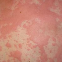  Urticaria (Hives)