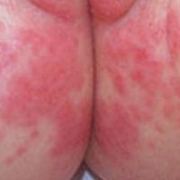  Yeast Diaper Rash (Candida)