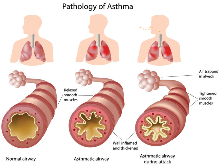 asthma