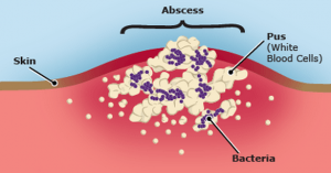 Abscesses in Children