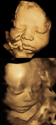 3D4D Ultrasound