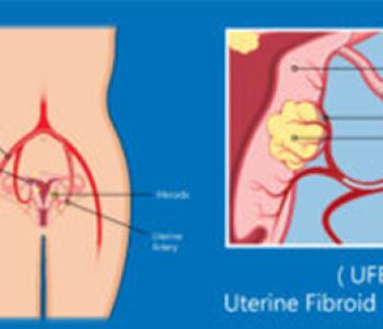 UFE For Uterine Fibroids