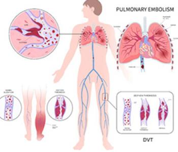 DVT Interventions