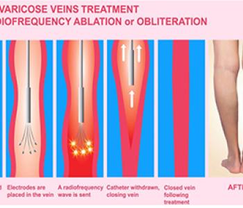 Ablation For Varicose Vein