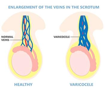 Varicocele Embolization